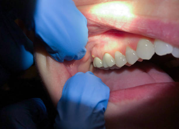 Best Emergency Dental Care for Broken or Chipped Teeth in High Ridge, MO
